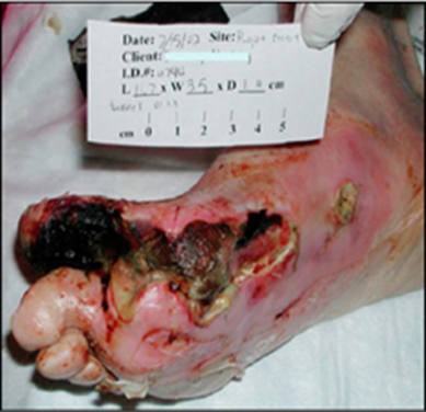 Infected foot